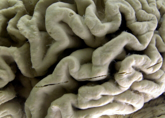 Study shows a blood test can help identify healthy people at high risk for Alzheimer’s disease