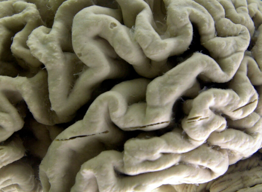 Study shows a blood test can help identify healthy people at high risk for Alzheimer’s disease