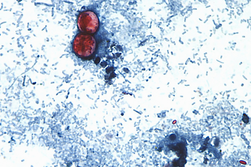 Michigan reports the first 2 US deaths related to a diarrhea-causing parasite